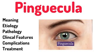 Pinguecula Conjunctival Anomalypinguecula eyes optometrists optometry [upl. by Mientao]