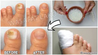 Do you suffer from nail fungus You have to do this  VERY IMPORTANT TIP [upl. by Kcaz709]