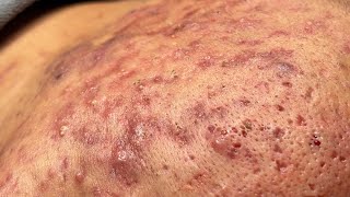 Acne Treatment Bo Nguyễn Spa  Blackheads On Tween Face 2024FULL [upl. by Atsylak298]