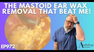 THE MASTOID EAR WAX REMOVAL THAT BEAT ME  EP972 [upl. by Catima318]