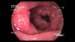 Double Balloon Enteroscopy in Crohns disease [upl. by Mychal906]