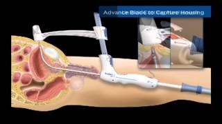 TSPeC® Illustrated Procedure  German [upl. by Ernst996]