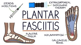 Understanding Plantar Fasciitis [upl. by Assin898]