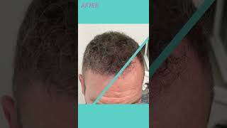 Hair Transplant with LifeTime Warranty  Longevita [upl. by Hambley]