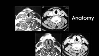 Radiology  Imaging of Larynx  Head and Neck [upl. by Nnanaej]