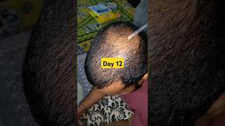 Day 12 of hair loss recovery journey  traya review  hair loss problem hairloss hairregrowth [upl. by Amolap]