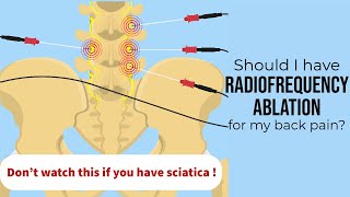 Spine surgeon When radiofrequency ablation is the right treatment for your low back pain [upl. by Arrej]