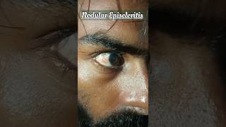 Noduler Episcleritis Live Demo Video nationalpandeyg eyecondition eyediseases [upl. by Araas]