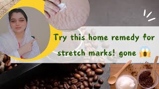 COFFEE and Coconut Oil Erase Stretch Marks FAST [upl. by Conchita150]