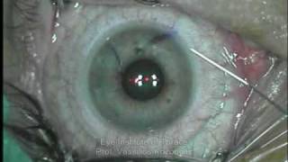 Refractive Surgery LASIK [upl. by Jonina]