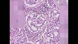 Histopathology LungAdenocarcinoma [upl. by Fronnia]