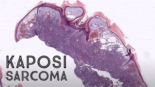 Kaposi sarcoma nodulartumor stage HHV8 HIV AIDS pathology dermpath dermatology [upl. by Shimkus]