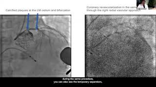 Litotricia Intravascular para el Manejo de Calcificaciones Arteriales [upl. by Ettennil]