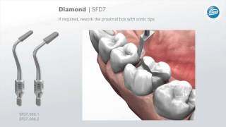 Preparation rules for ceramic inlays and partial crowns [upl. by Durkee]