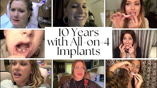 10 Years with Dental Implants [upl. by Nabetse318]