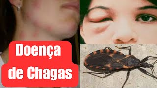 Doença de Chagas o que você precisa saber [upl. by Malorie]