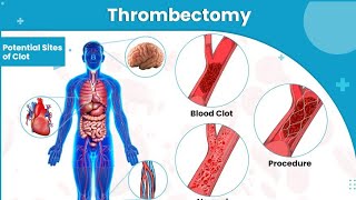 Endovascular thrombectomy  is a invasive surgical procedure treat acute ischemic stroke [upl. by Cordell]