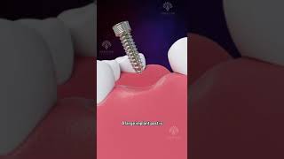 Bone Grafting for Dental Implants shorts facts  creativelearning3d [upl. by Aiciled]