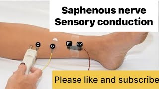 SAPHENOUS NERVE sensory nerve NCS neurology neurotech [upl. by Gnilyam]