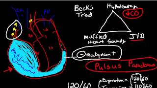 Oncologic Emergencies Cardiac Tamponade [upl. by Nageem]