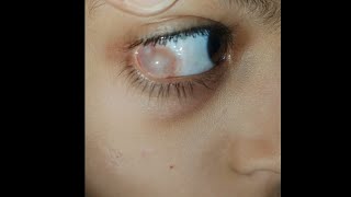 Hidden Swelling in eyes 👀  condition explained indetail eyecareoptom5506 eye eyelid swelling [upl. by Ayatahs201]