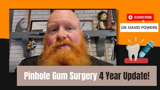 Pinhole Gum Surgery 4 Year Update [upl. by Medardas]