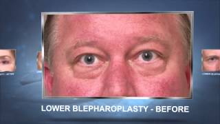 Lower Blepharoplasty  Eyelid Lift Surgery in Houston [upl. by Anelim]