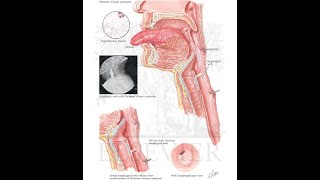 Plummer Vinson Syndrome [upl. by Arbe323]