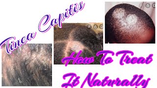 Tinea Capitis How To Treat It Naturally Diagnosedupdatetreatment [upl. by Assetniuq]