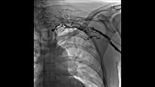 Left Upper Extremity Venogram of Thrombosis of Left Subclavian Vein With Network of Small Veins [upl. by Etteniotna]