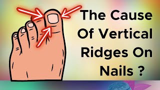 Do You Have Vertical Ridges On Your Nails Cause [upl. by Arol]