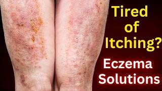 Dermatologist’s Guide to Beating Eczema [upl. by Lilas]