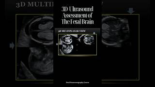 3D Ultrasound Assessment of The Fetal Brain [upl. by Esertak327]