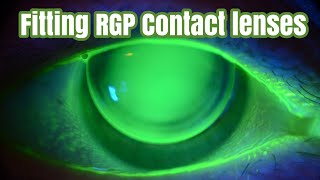 Fitting RGP Contact lenses [upl. by Leunas]