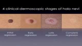 Halo Nevus  White Circles On Skin TREATMENT [upl. by Ianthe]