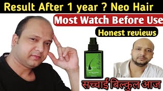 MY Honest Reviews After 1 Year Using Neo Hair Lotion 🤔 [upl. by Phillip]