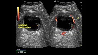 Simple renal cyst with septated calcification 격막 석회화 동반 신낭종 [upl. by Andromede]