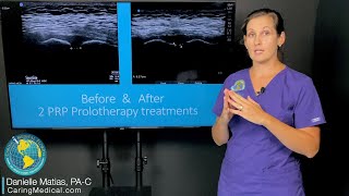 PRP Prolotherapy for pelvic pain amp pubic symphysis injury amp ultrasound as an objective measurement [upl. by Nerral]