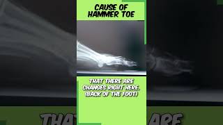 Is Your Foot Pain Caused by Hammer Toe hammertoes [upl. by Rana204]