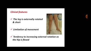 Orthopaedics Slipped Capital Femoral Epiphysis [upl. by Haldane]