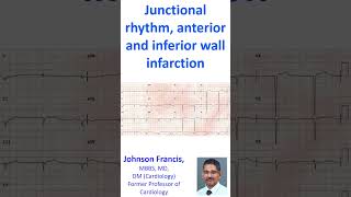 Junctional rhythm anterior and inferior wall infarction [upl. by Mattheus657]