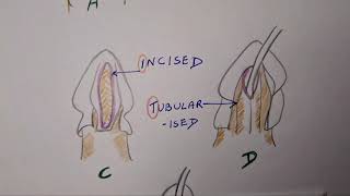 Hypospadias  TIP [upl. by Scrivings923]