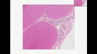 Histopathology Brain Acute pyogenic bacterial meningitis [upl. by Lundt]