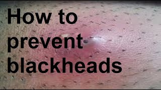 How to prevent blackheads [upl. by Willtrude555]