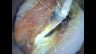 Ear Wax Removal Blocked ear Illuminated Jobson Horn [upl. by Atsylak872]