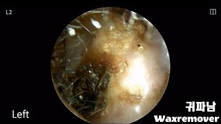 ep35 Earwax removal [upl. by Nezam728]