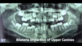 NonExtraction Treatment of Bilateral Impaction of Upper Canines  Dina 14yrs [upl. by Oirromed118]