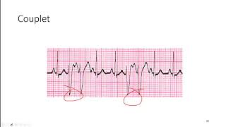 ECG 9 Ventricular DysArrhythmias [upl. by Enayd]