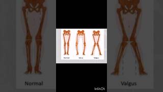 coxa varacoxa valgumgenu valga genu valgum biomechanics in tamil biomechanics [upl. by Aratak78]