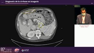 Diagnostic de la cirrhose en imagerie  R Sartoris [upl. by Amitak588]